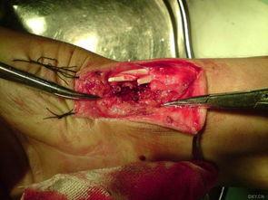 动脉破裂图片,揭秘血管破裂的惊心动魄